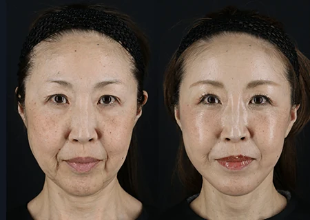 フェイスリフトと脂肪吸引・脂肪注入の術前と術後半年の比較（正面）