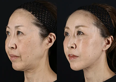 フェイスリフトと脂肪吸引・脂肪注入の術前と術後半年の比較（別角度）