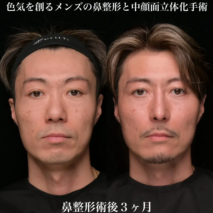 男性の自家組織を用いた鼻形成の術前と術後3か月の正面比較