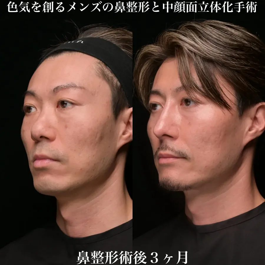 男性の自家組織を用いた鼻形成の術前と術後3か月の斜位比較