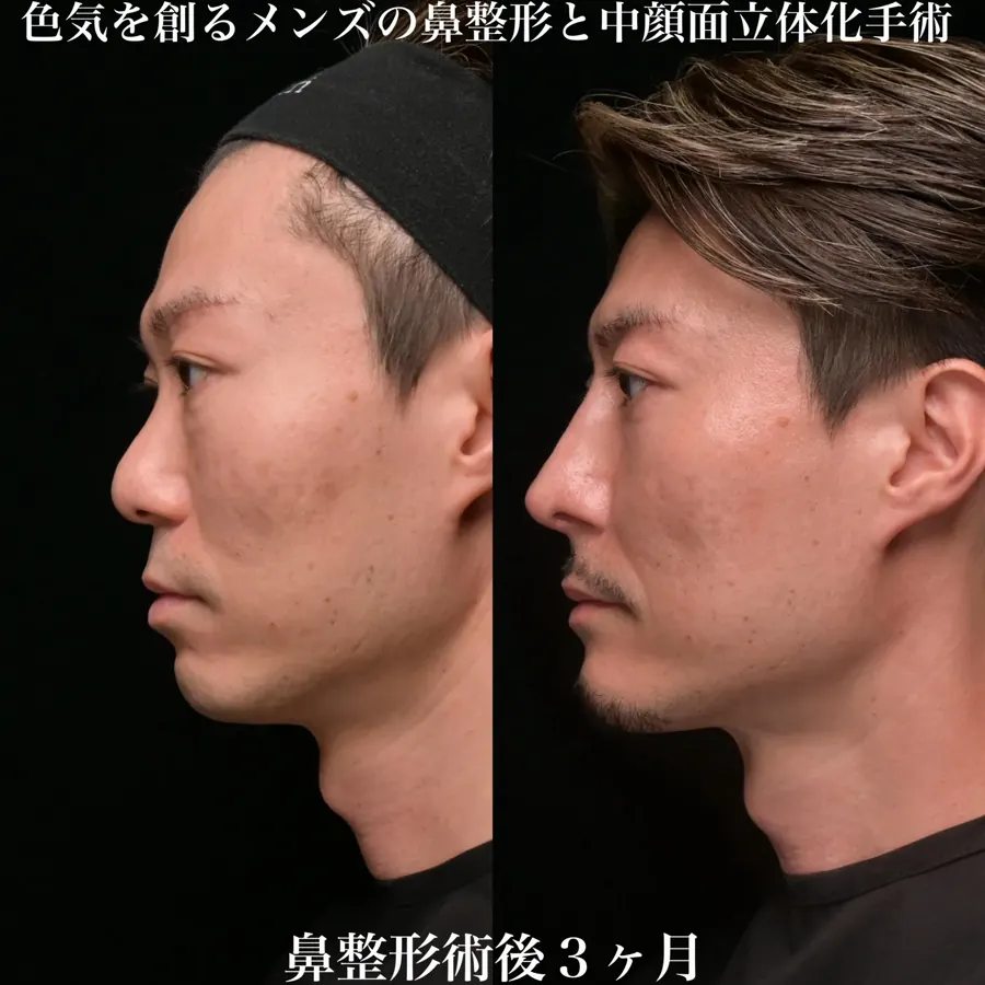 男性の自家組織を用いた鼻形成の術前と術後3か月の側面比較