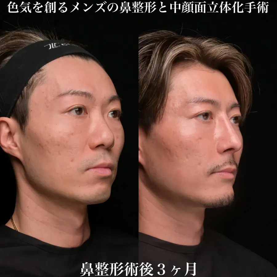 男性の自家組織を用いた鼻形成の術前と術後3か月の反対側斜位比較