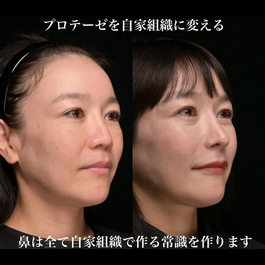 鼻プロテーゼから自家組織へ入れ替えた施術前後の斜位比較