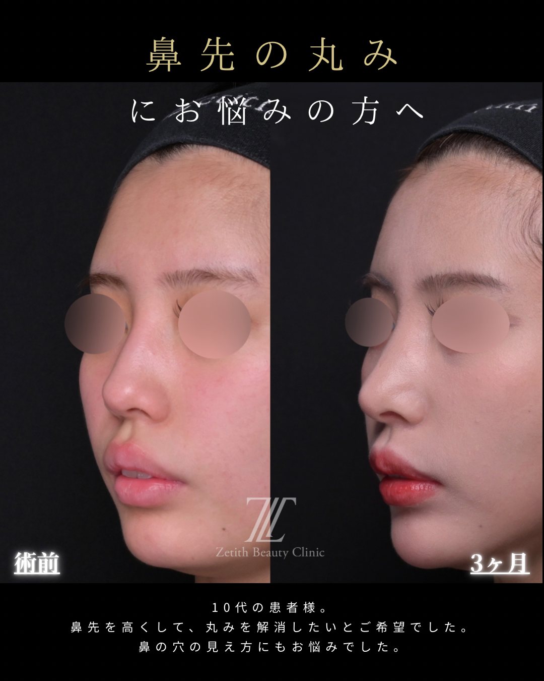 団子鼻 クローズド法 斜め 術前・術後3ヶ月