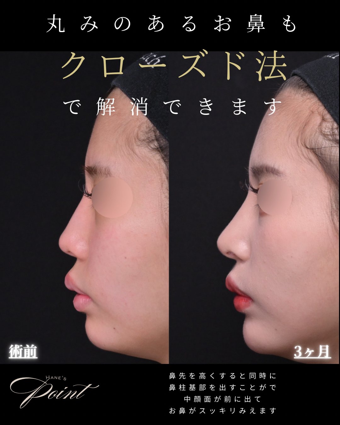 団子鼻 クローズド法 横 術前・術後3ヶ月