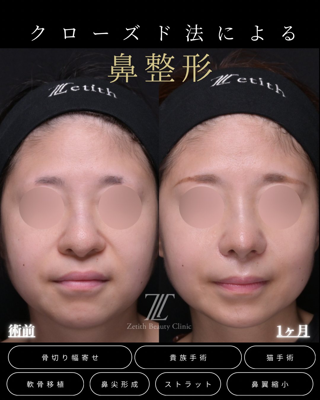貴族手術を含む症例（正面）