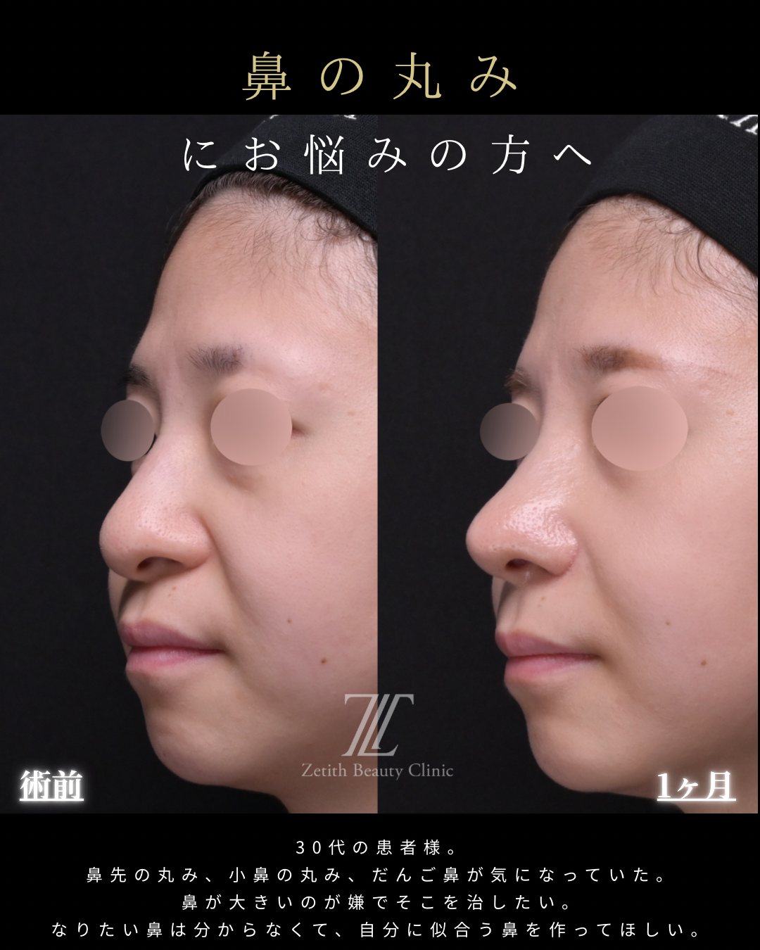 貴族手術 斜め 術前・術後