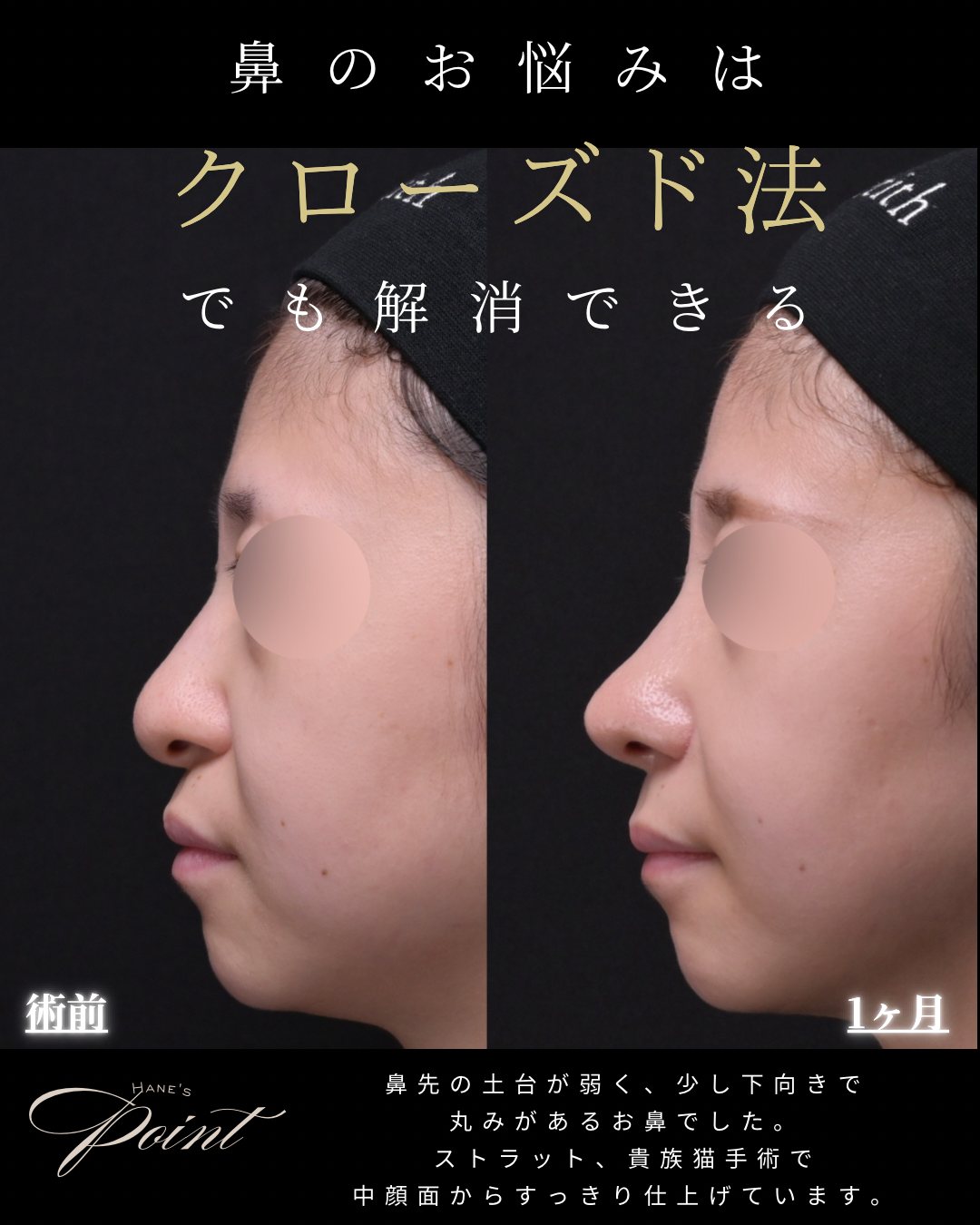 貴族手術 横 術前・術後