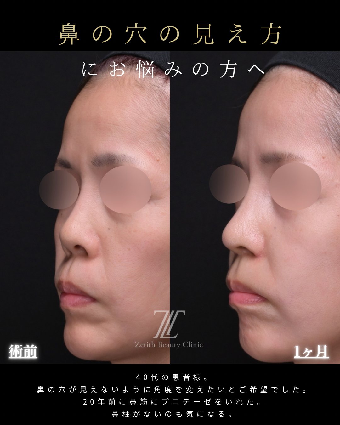 猫手術を含む鼻整形 斜め 術前・術後1ヶ月(鼻の穴の見え方・鼻柱の付け根)
