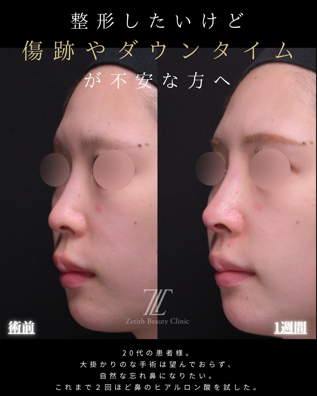 鼻筋の低さ クローズド法 斜め 術前・術後