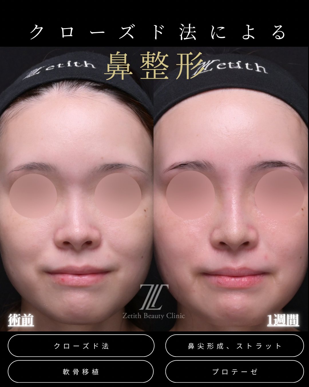 ããããŒãŒé錻ãå«ã錻æŽåœ¢ æ£é¢ è¡åã»è¡åŸ1é±é