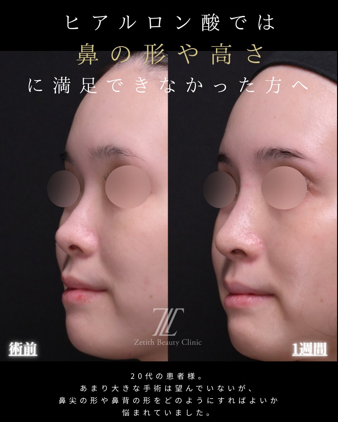 ããããŒãŒé錻ãå«ã錻æŽåœ¢ æã è¡åã»è¡åŸ1é±é