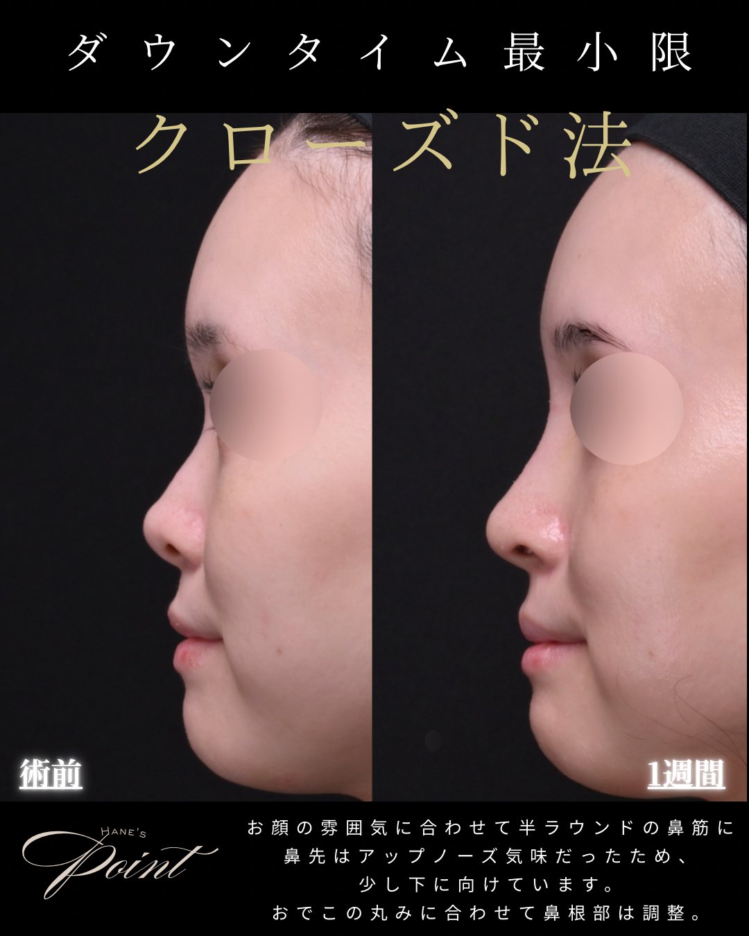 プロテーゼ隆鼻を含む症例（横顔）