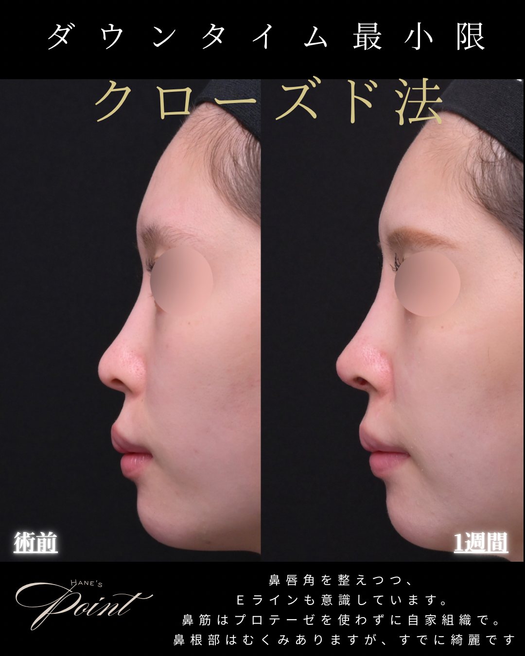 鼻筋の低さ クローズド法 横 術前・術後