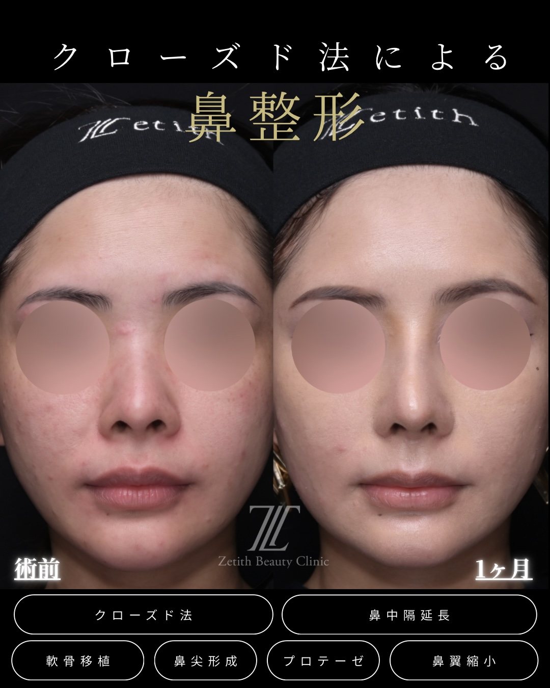 鼻先を高く クローズド法 正面 術前・術後