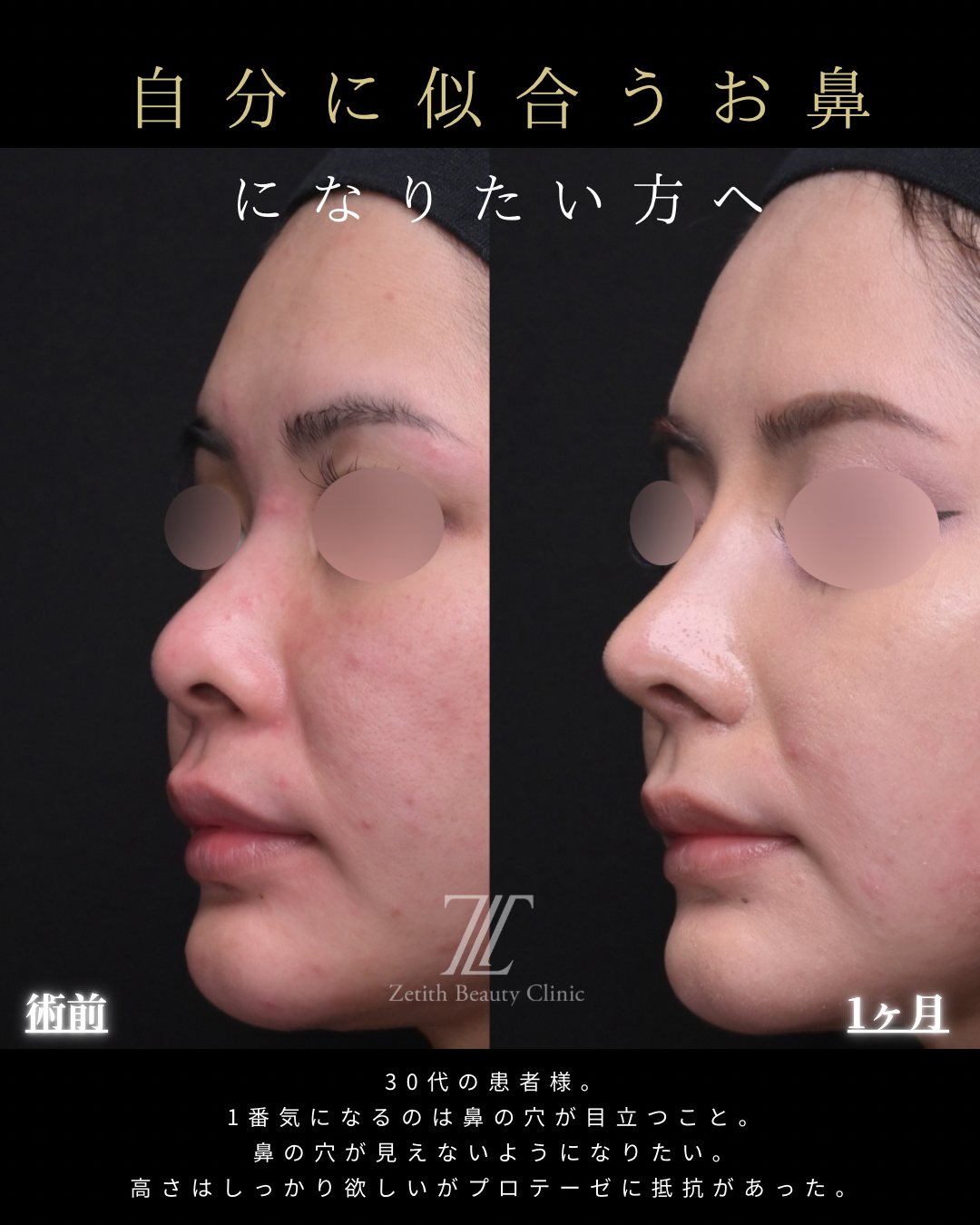 鼻先を高く クローズド法 斜め 術前・術後