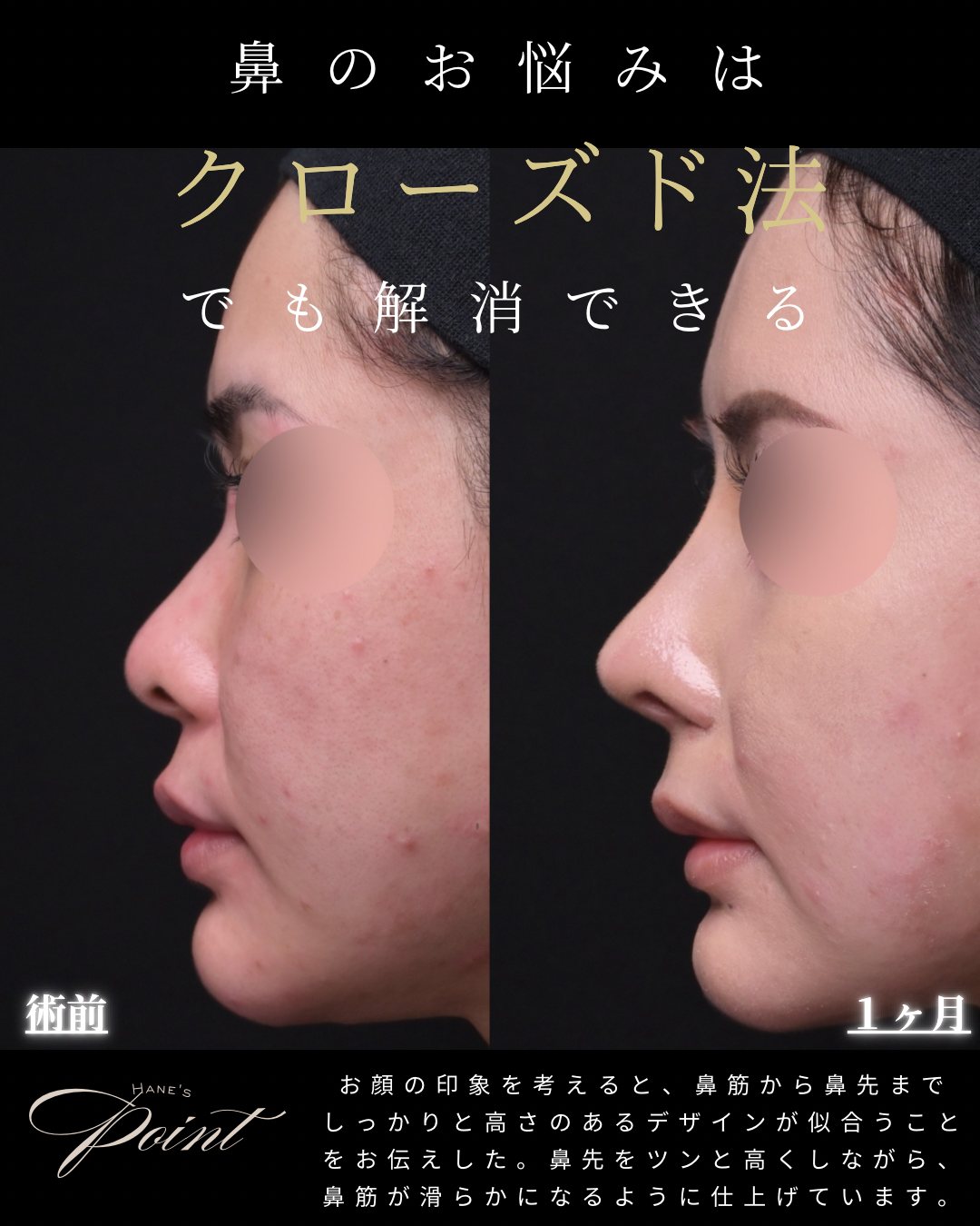 鼻中隔延長の症例（横顔）
