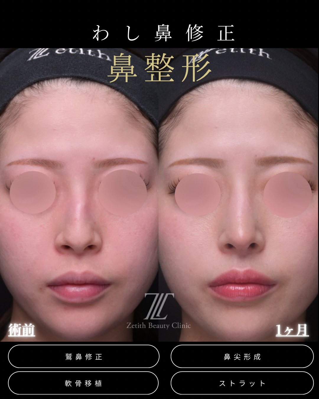 わし鼻・鷲鼻修正 正面 術前・術後1ヶ月