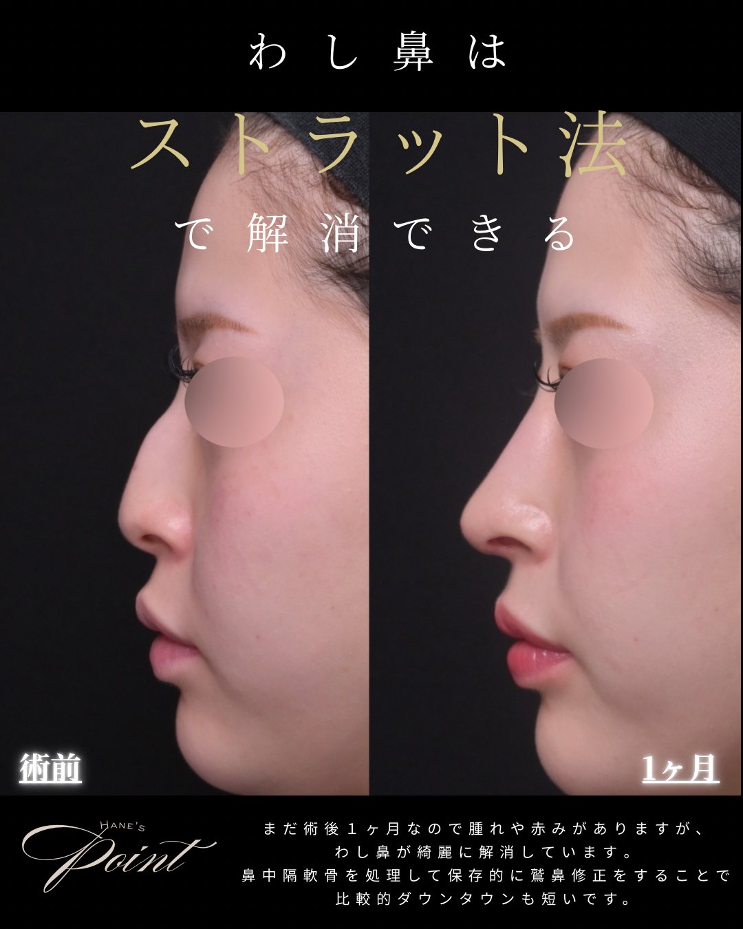 わし鼻・鷲鼻修正の症例（横顔）