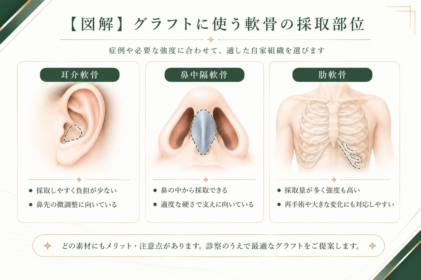 鼻整形の術式・軟骨移植の図解