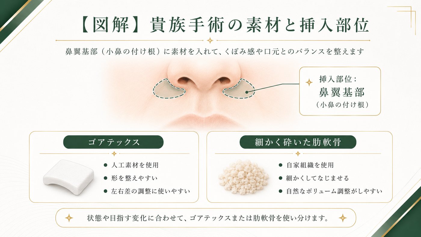 貴族手術・小鼻の付け根にゴアテックスや肋軟骨を入れる位置の図解