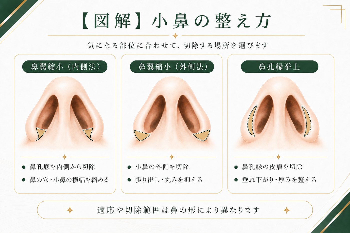 小鼻の整え方の図解：内側法・外側法・鼻孔縁挙上で切除する場所の違い