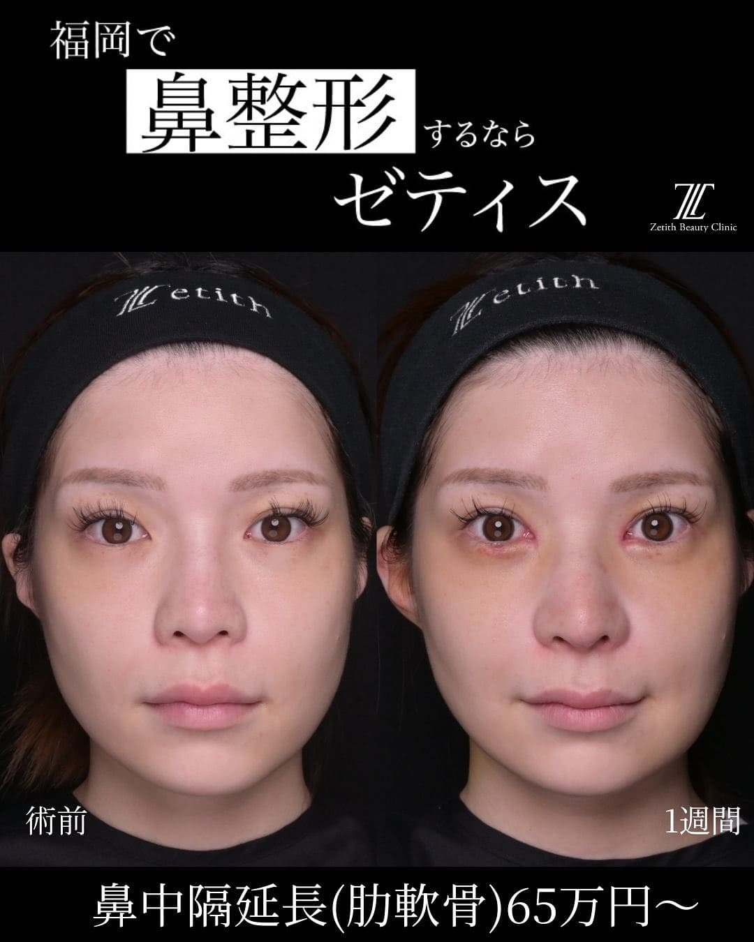 羽根医師による鼻整形・目頭切開の術前/術後1週間｜ゼティス