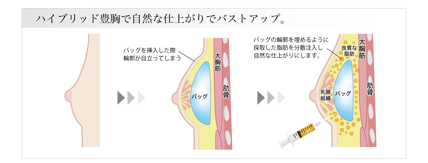 ハイブリッド豊胸 - ゼティスビューティークリニック｜鼻整形・鼻形成、美肌専門美容クリニック