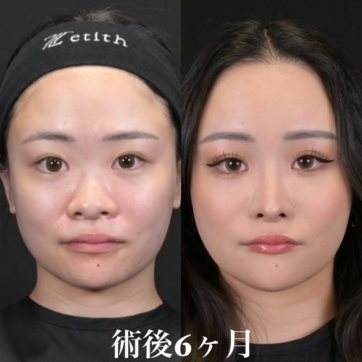 鼻整形6か月後