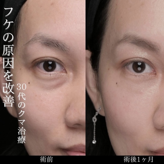 目の下のクマ取り施術のビフォーアフター写真