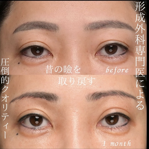 眉下切開のビフォーアフター写真