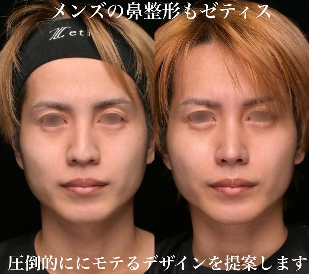 鼻整形のビフォーアフター写真(術前)