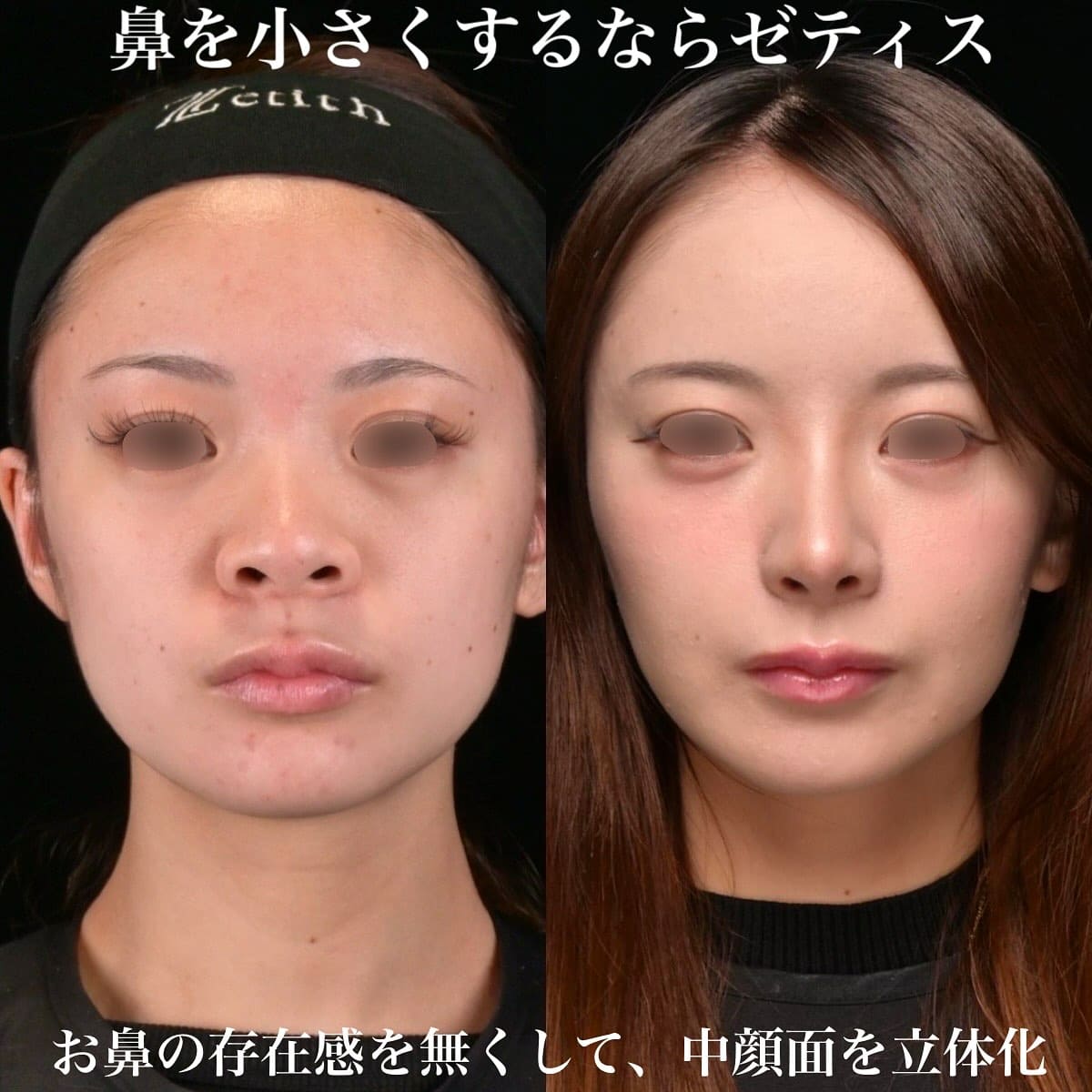 鼻整形のビフォーアフター写真(術前)