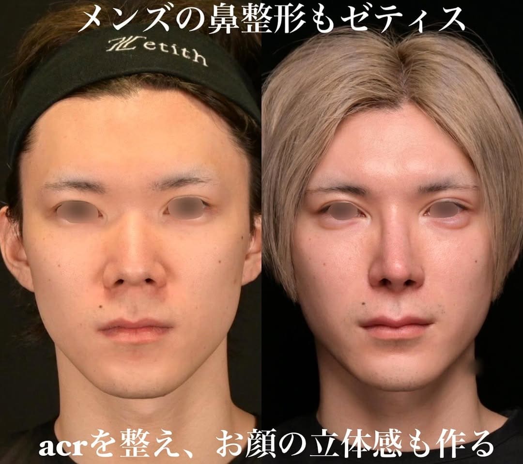 鼻整形のビフォーアフター写真(術前)