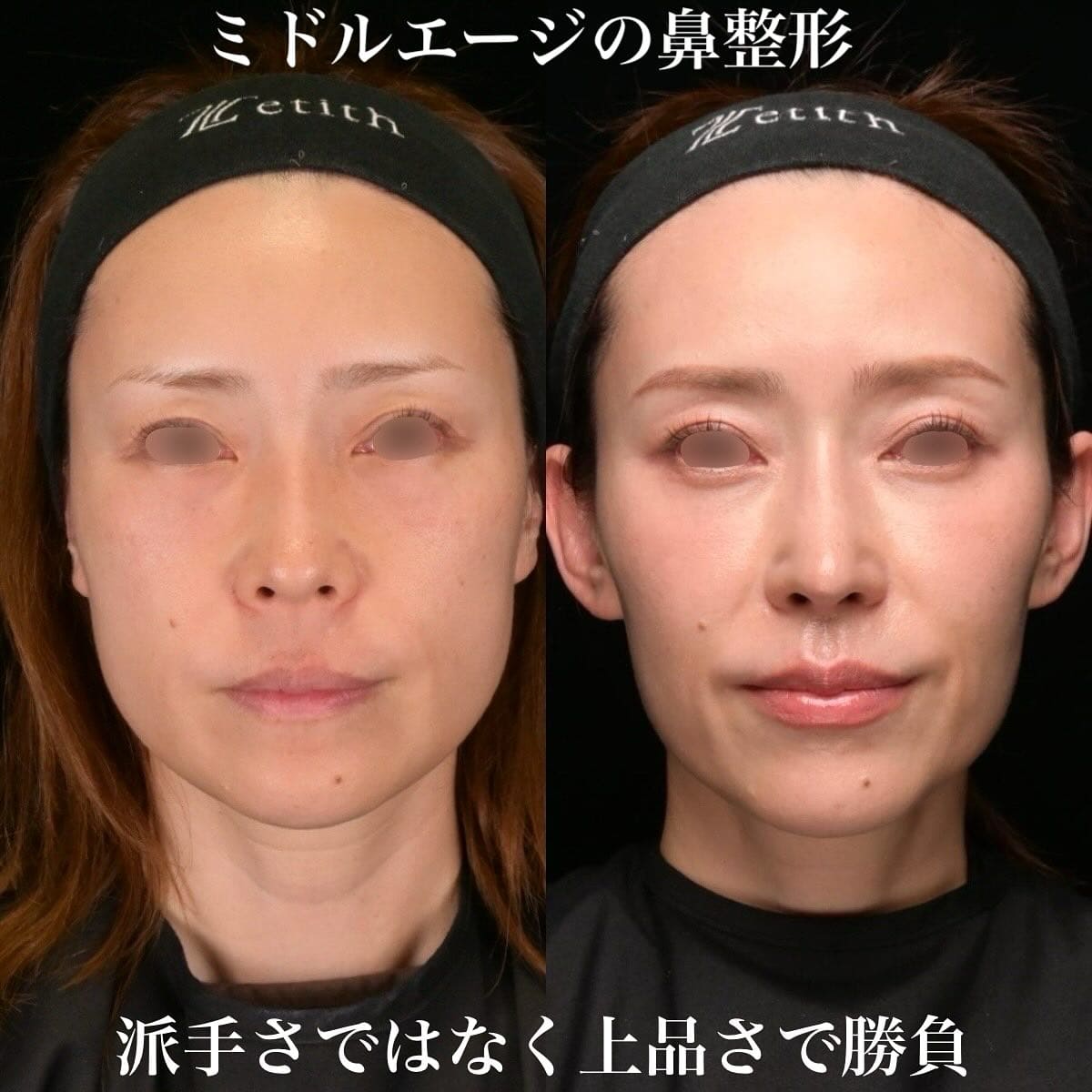 鼻整形のビフォーアフター写真(術前)