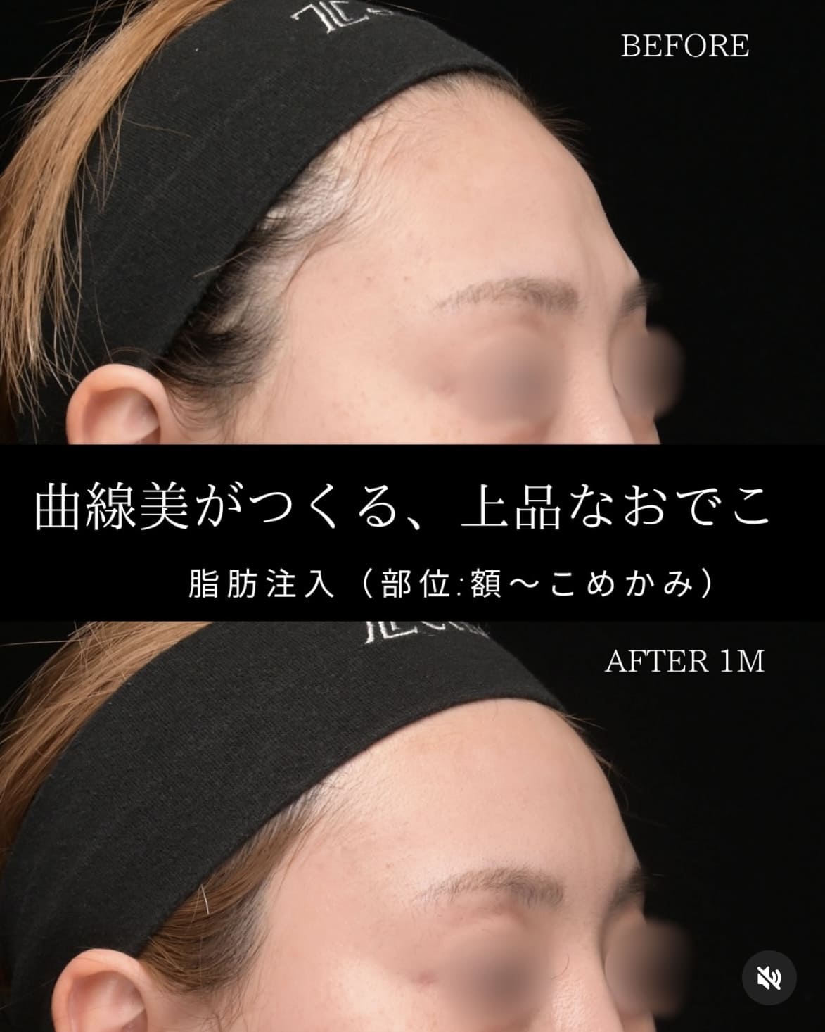 脂肪注入のビフォーアフター写真