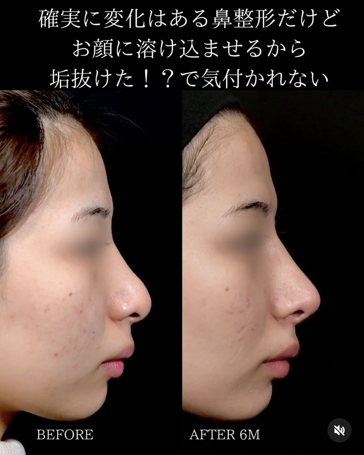 鼻整形のビフォーアフター写真