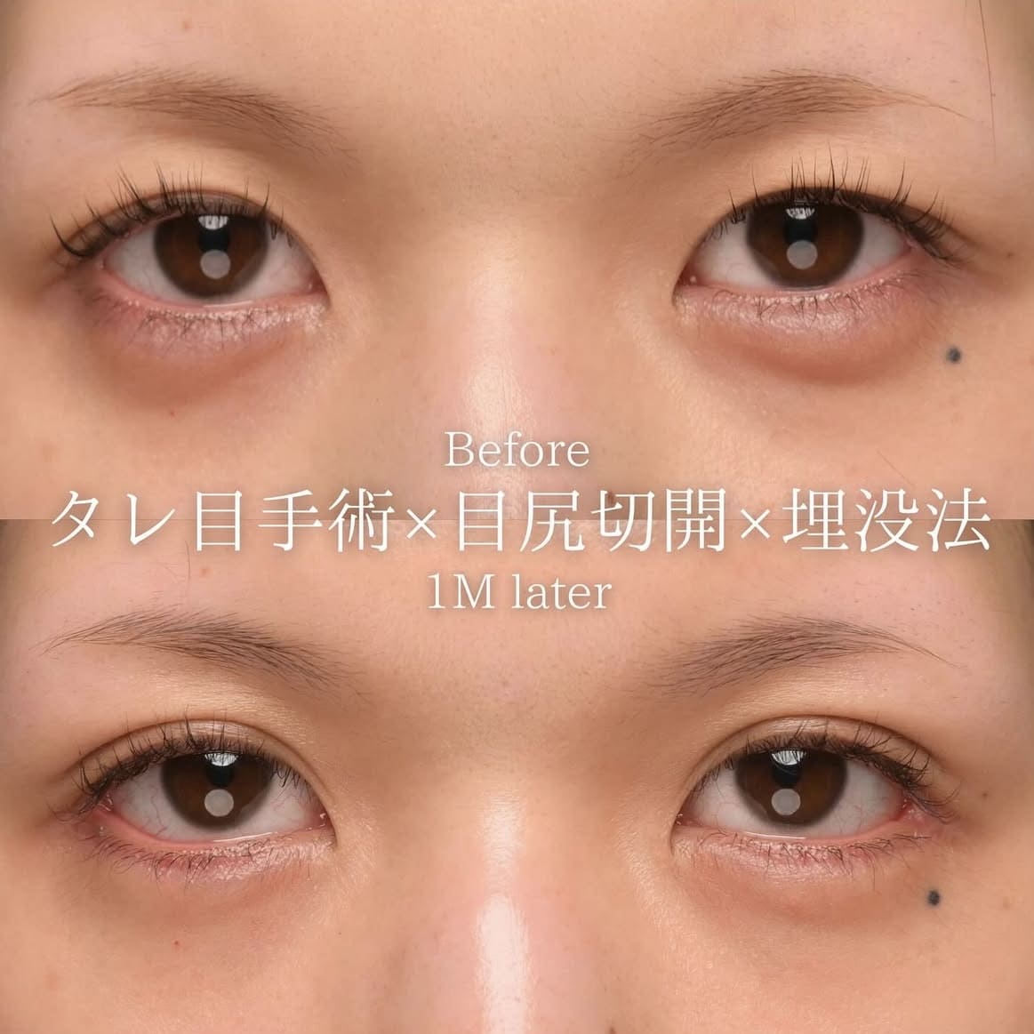 タレ目形成と埋没法のビフォーアフターの写真