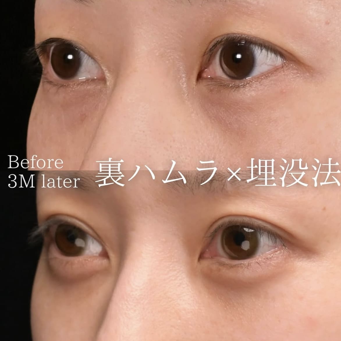 裏ハムラ法と埋没法のビフォーアフターの写真