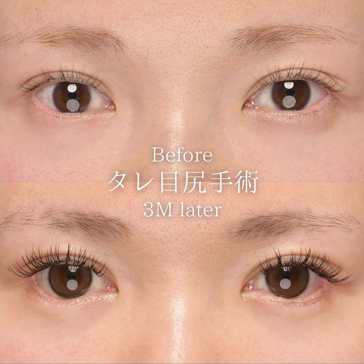 タレ目形成のビフォーアフターの写真