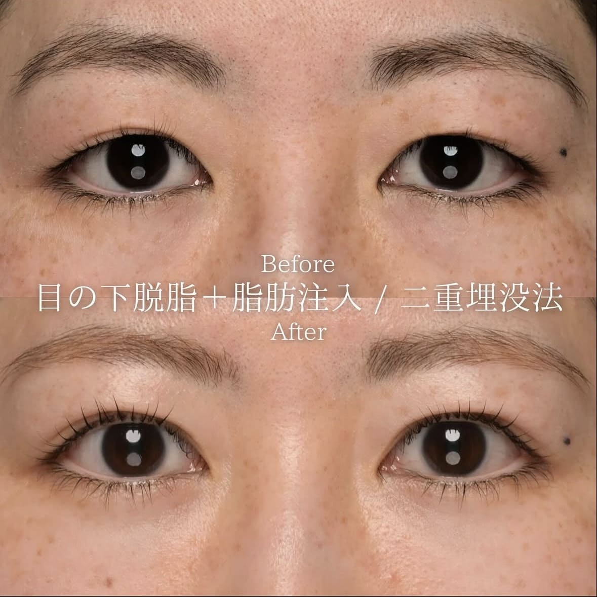 クマ治療と脂肪注入と埋没法のビフォーアフターの写真
