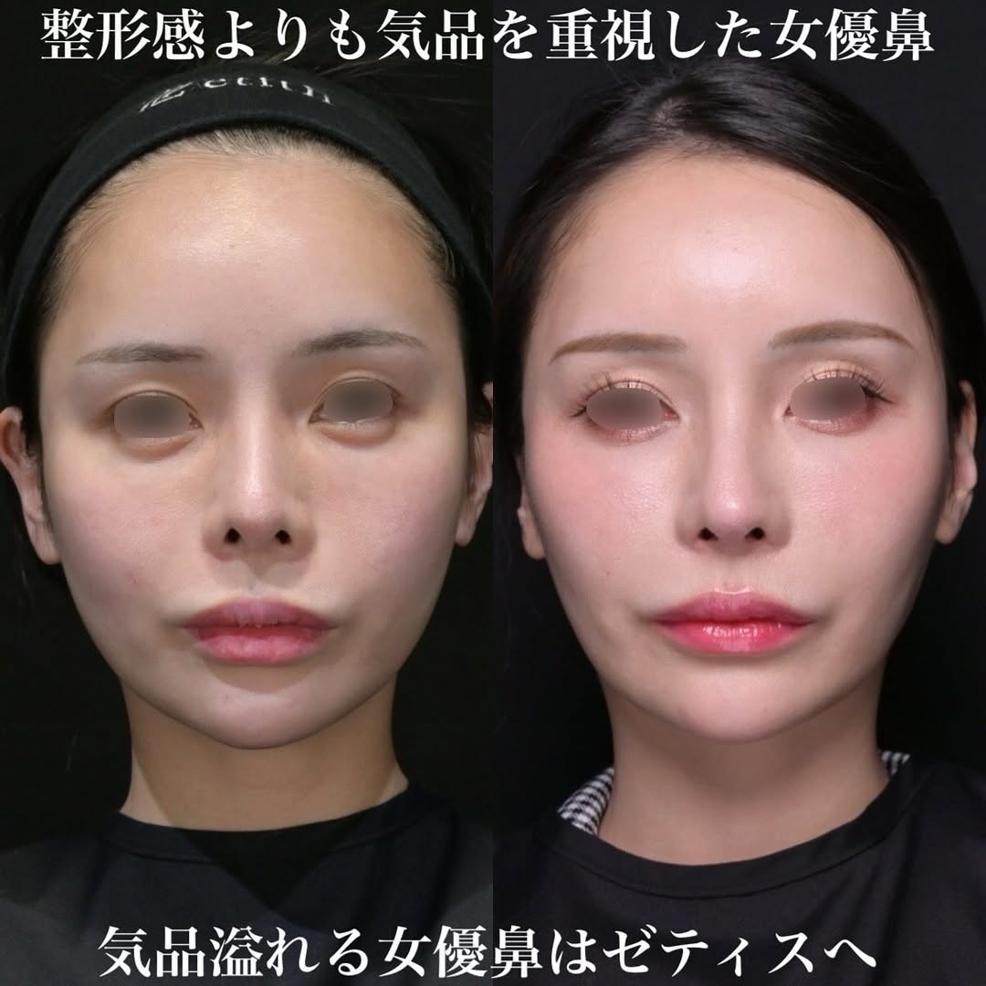 女優鼻