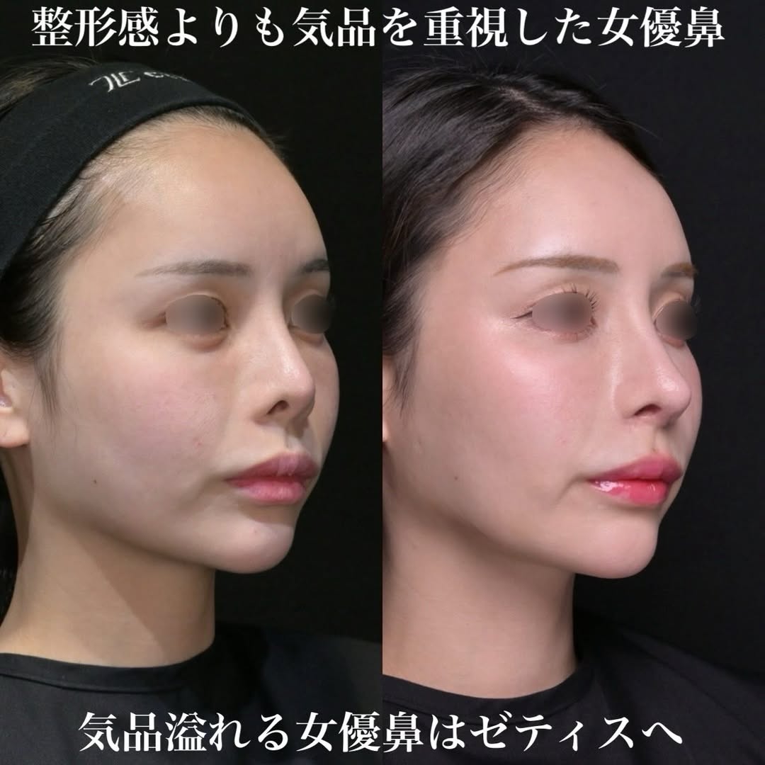 女優鼻