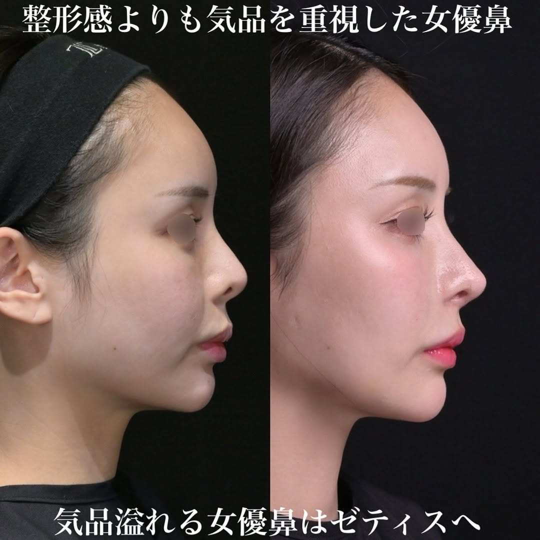 女優鼻