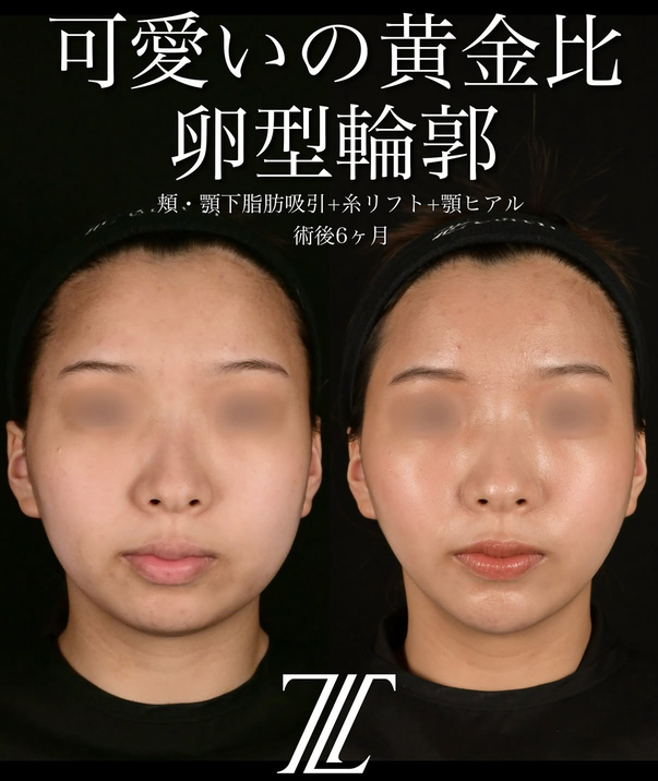 ショッピングリフト - ゼティスビューティークリニック｜鼻整形・鼻