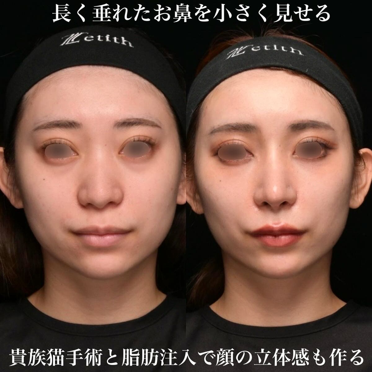 鼻整形のビフォーアフター写真(術前)
