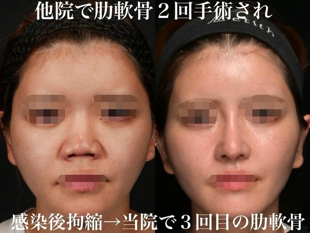 鼻整形のビフォーアフター写真(術前)