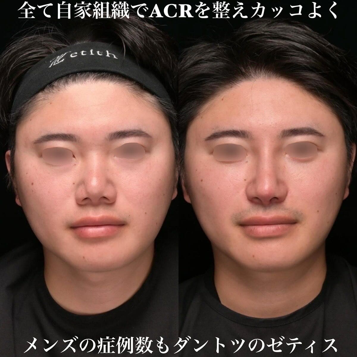 鼻整形のビフォーアフター写真(術前)