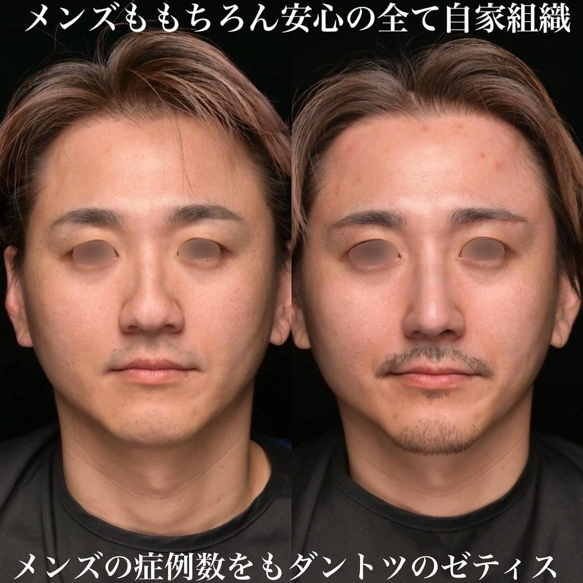 鼻整形のビフォーアフター写真(術前)