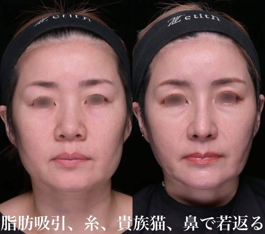 鼻整形のビフォーアフター写真(術前)
